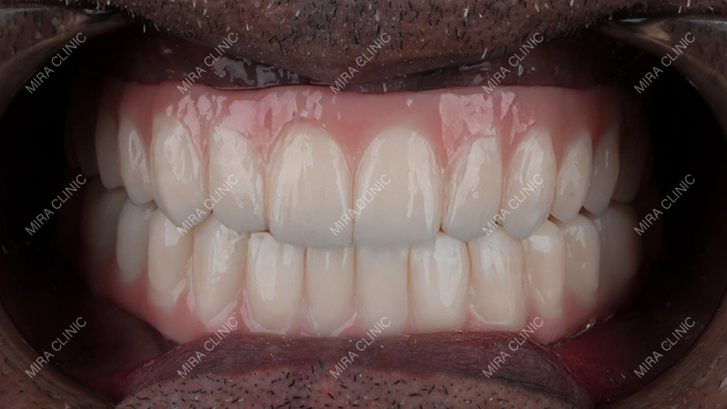 full mouth implant
